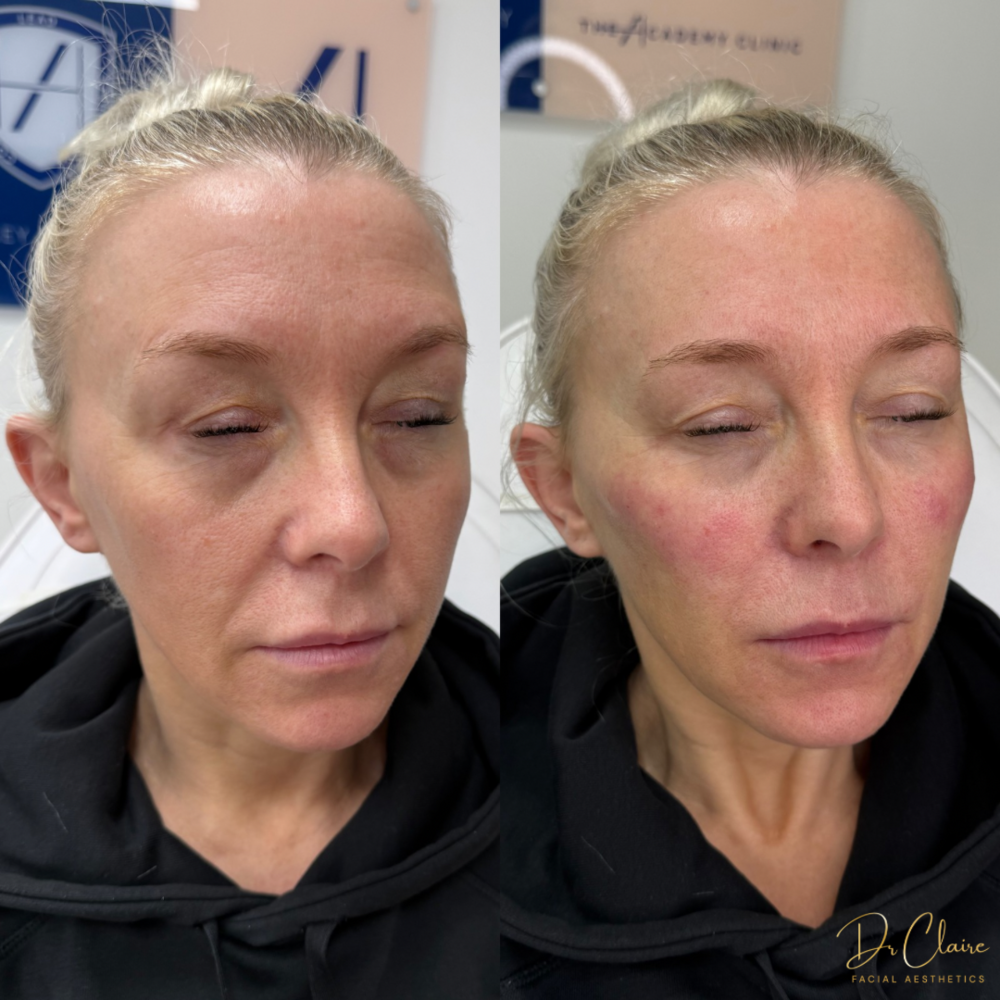 Transformations | Dr Claire Facial Aesthetics | Botox Chorley | Fillers Chorley | Aesthetics Chorley | Botox Treatments Chorley | Dermal Fillers Chorley | Aesthetic Enhancements Chorley