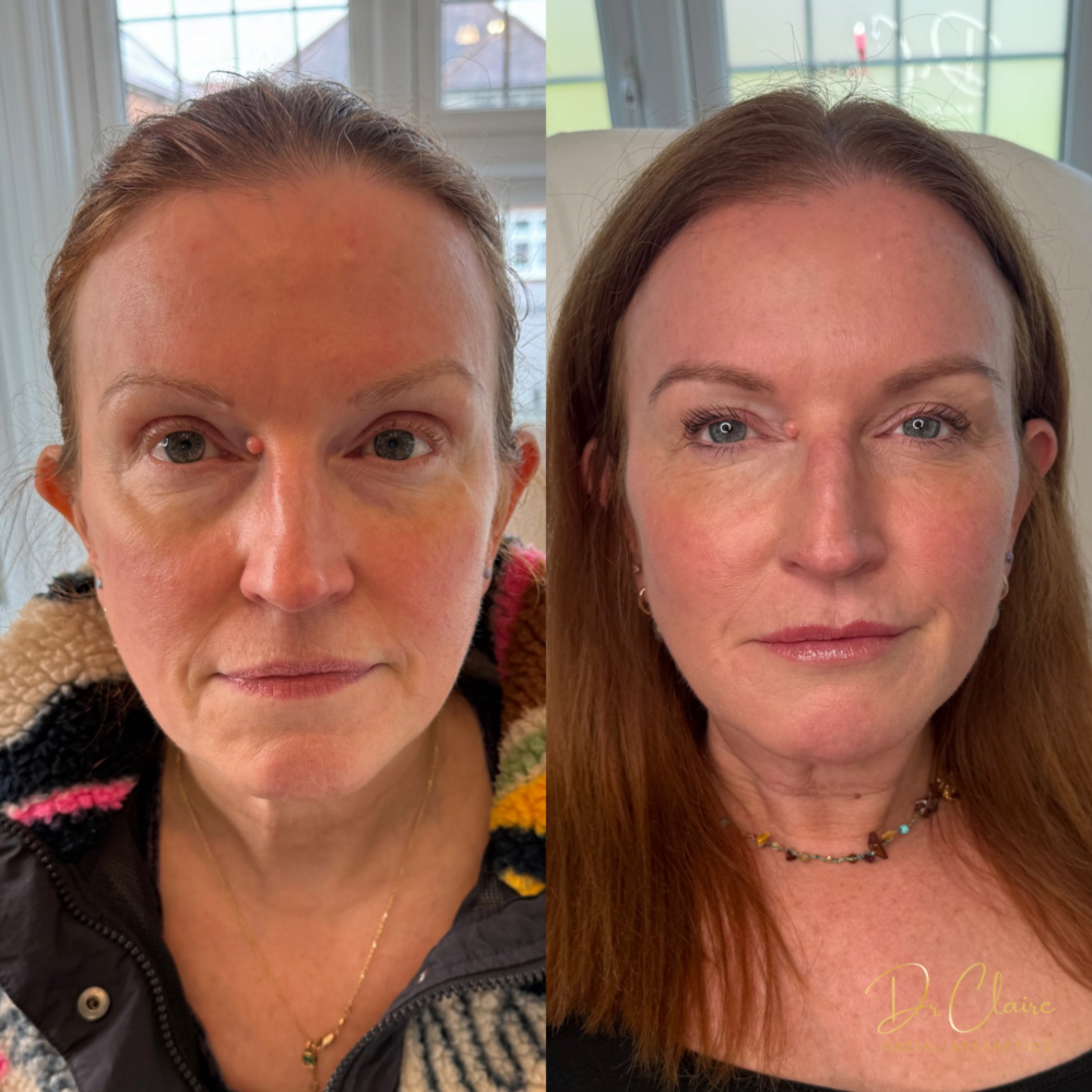 Transformations | Dr Claire Facial Aesthetics | Botox Chorley | Fillers Chorley | Aesthetics Chorley | Botox Treatments Chorley | Dermal Fillers Chorley | Aesthetic Enhancements Chorley