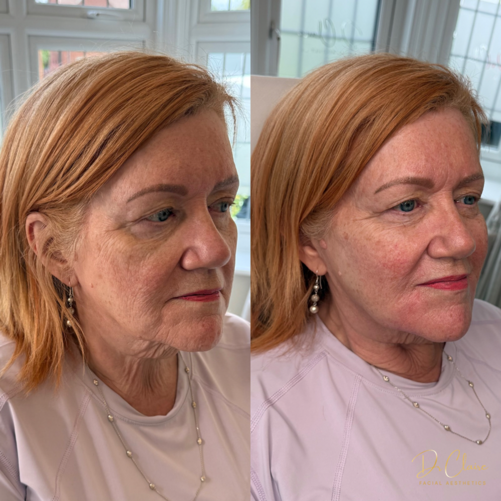 Transformations | Dr Claire Facial Aesthetics | Botox Chorley | Fillers Chorley | Aesthetics Chorley | Botox Treatments Chorley | Dermal Fillers Chorley | Aesthetic Enhancements Chorley