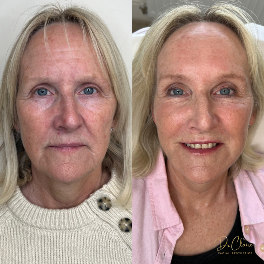 Transformations | Dr Claire Facial Aesthetics | Botox Chorley | Fillers Chorley | Aesthetics Chorley | Botox Treatments Chorley | Dermal Fillers Chorley | Aesthetic Enhancements Chorley