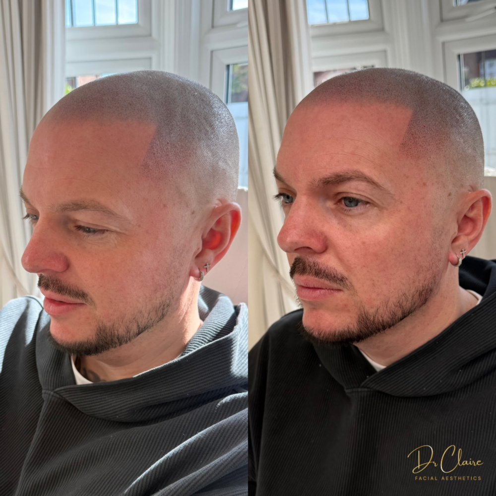 Transformations | Dr Claire Facial Aesthetics | Botox Chorley | Fillers Chorley | Aesthetics Chorley | Botox Treatments Chorley | Dermal Fillers Chorley | Aesthetic Enhancements Chorley