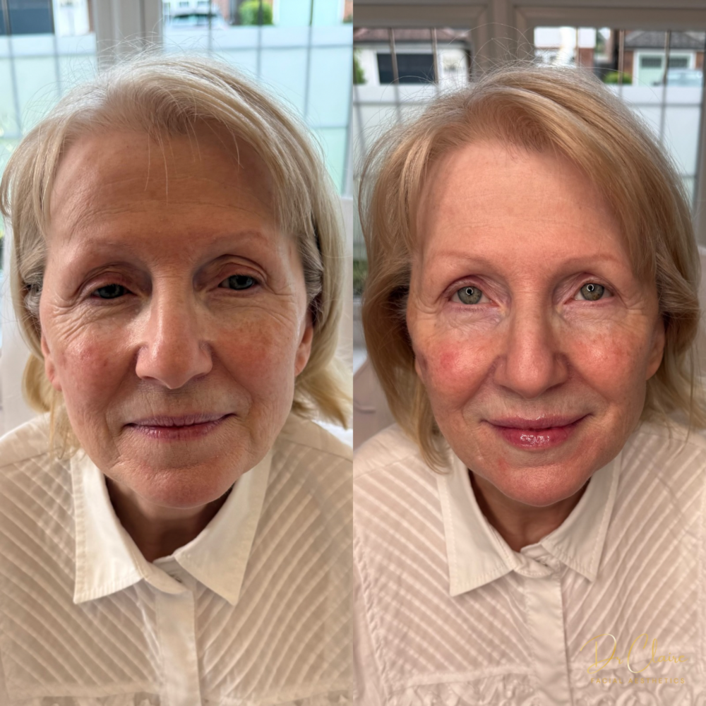 Transformations | Dr Claire Facial Aesthetics | Botox Chorley | Fillers Chorley | Aesthetics Chorley | Botox Treatments Chorley | Dermal Fillers Chorley | Aesthetic Enhancements Chorley
