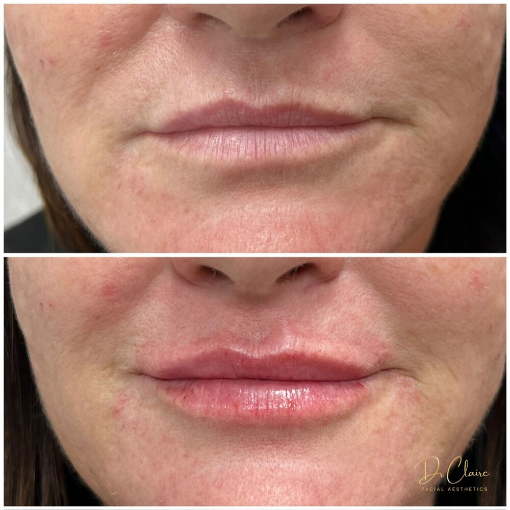 Transformations | Dr Claire Facial Aesthetics | Botox Chorley | Fillers Chorley | Aesthetics Chorley | Botox Treatments Chorley | Dermal Fillers Chorley | Aesthetic Enhancements Chorley