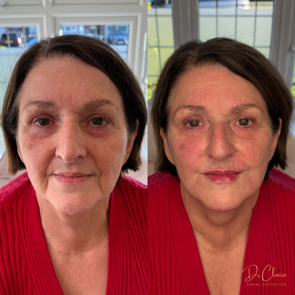 Transformations | Dr Claire Facial Aesthetics | Botox Chorley | Fillers Chorley | Aesthetics Chorley | Botox Treatments Chorley | Dermal Fillers Chorley | Aesthetic Enhancements Chorley