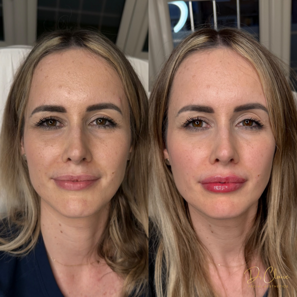 Transformations | Dr Claire Facial Aesthetics | Botox Chorley | Fillers Chorley | Aesthetics Chorley | Botox Treatments Chorley | Dermal Fillers Chorley | Aesthetic Enhancements Chorley