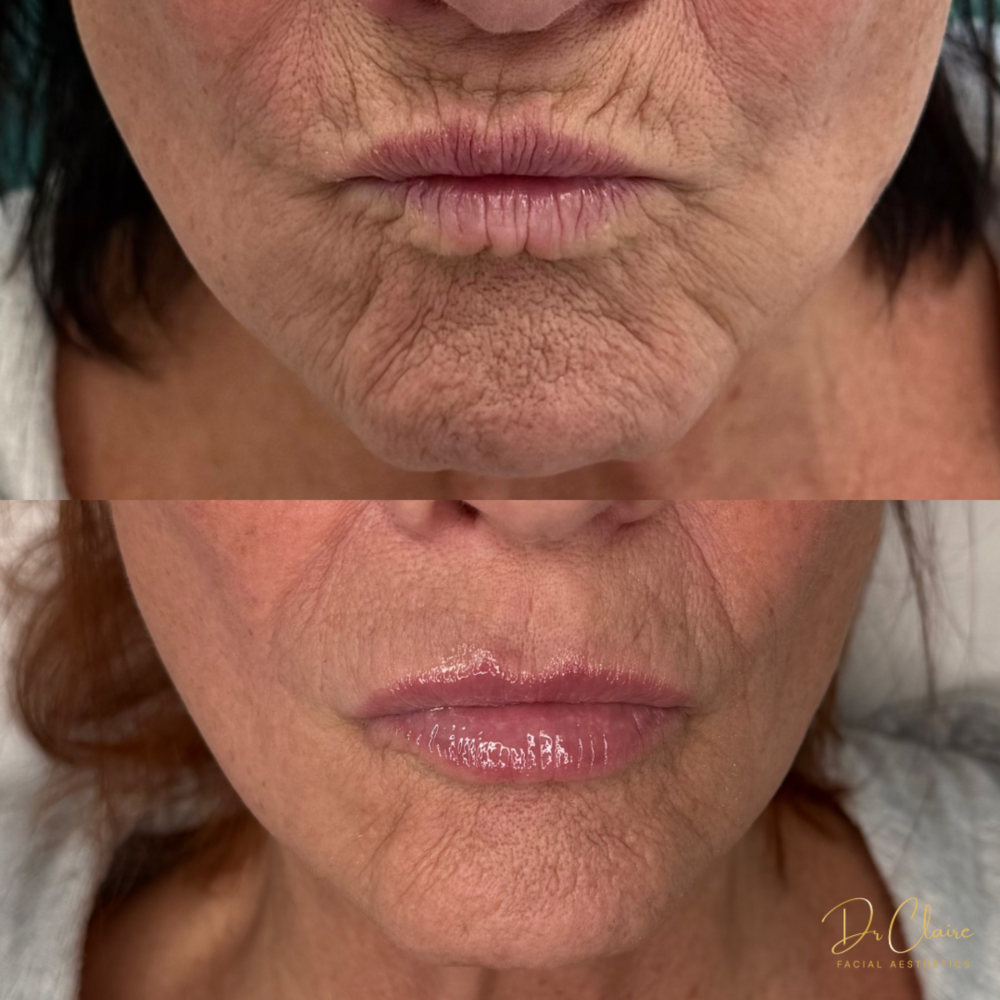Transformations | Dr Claire Facial Aesthetics | Botox Chorley | Fillers Chorley | Aesthetics Chorley | Botox Treatments Chorley | Dermal Fillers Chorley | Aesthetic Enhancements Chorley