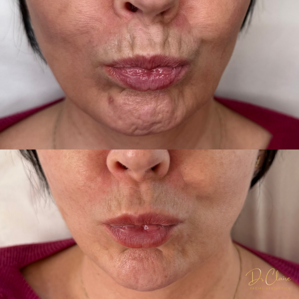 Transformations | Dr Claire Facial Aesthetics | Botox Chorley | Fillers Chorley | Aesthetics Chorley | Botox Treatments Chorley | Dermal Fillers Chorley | Aesthetic Enhancements Chorley