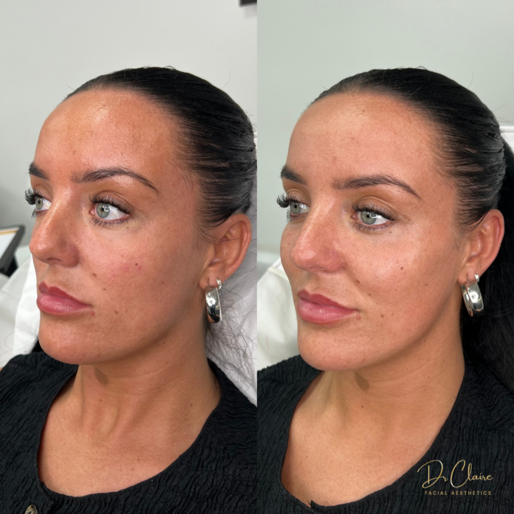 Transformations | Dr Claire Facial Aesthetics | Botox Chorley | Fillers Chorley | Aesthetics Chorley | Botox Treatments Chorley | Dermal Fillers Chorley | Aesthetic Enhancements Chorley