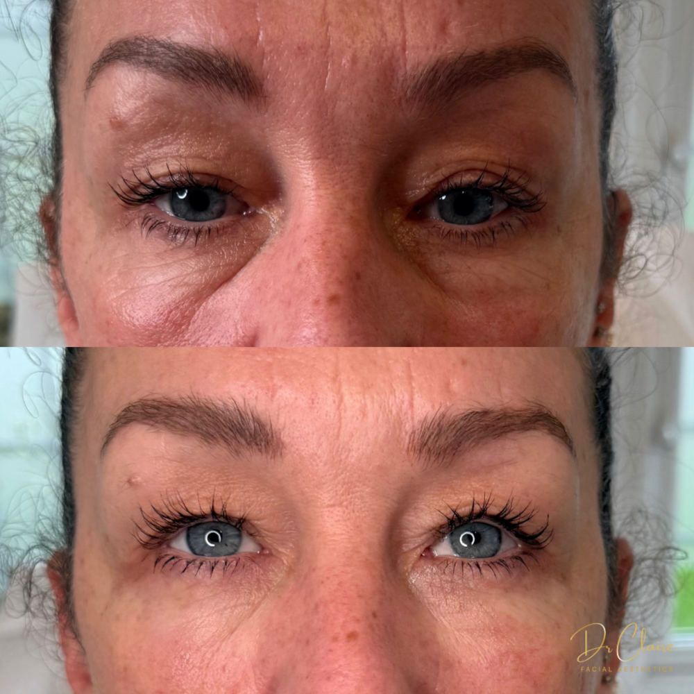 Transformations | Dr Claire Facial Aesthetics | Botox Chorley | Fillers Chorley | Aesthetics Chorley | Botox Treatments Chorley | Dermal Fillers Chorley | Aesthetic Enhancements Chorley
