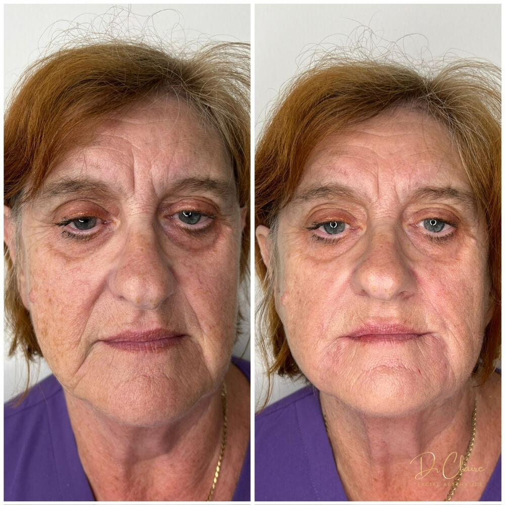 Transformations | Dr Claire Facial Aesthetics | Botox Chorley | Fillers Chorley | Aesthetics Chorley | Botox Treatments Chorley | Dermal Fillers Chorley | Aesthetic Enhancements Chorley