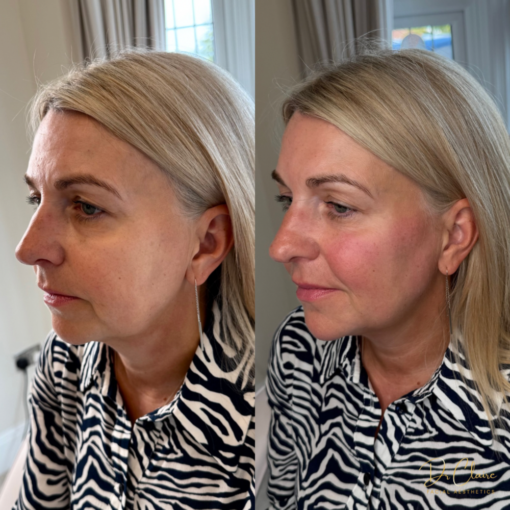 Transformations | Dr Claire Facial Aesthetics | Botox Chorley | Fillers Chorley | Aesthetics Chorley | Botox Treatments Chorley | Dermal Fillers Chorley | Aesthetic Enhancements Chorley