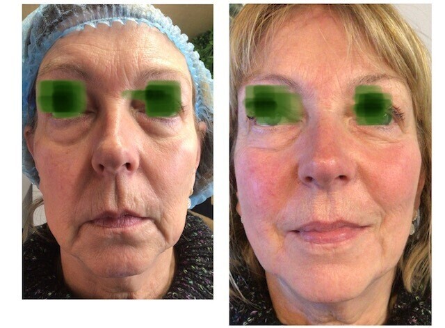 Before &amp; After | Clk medical aesthetics