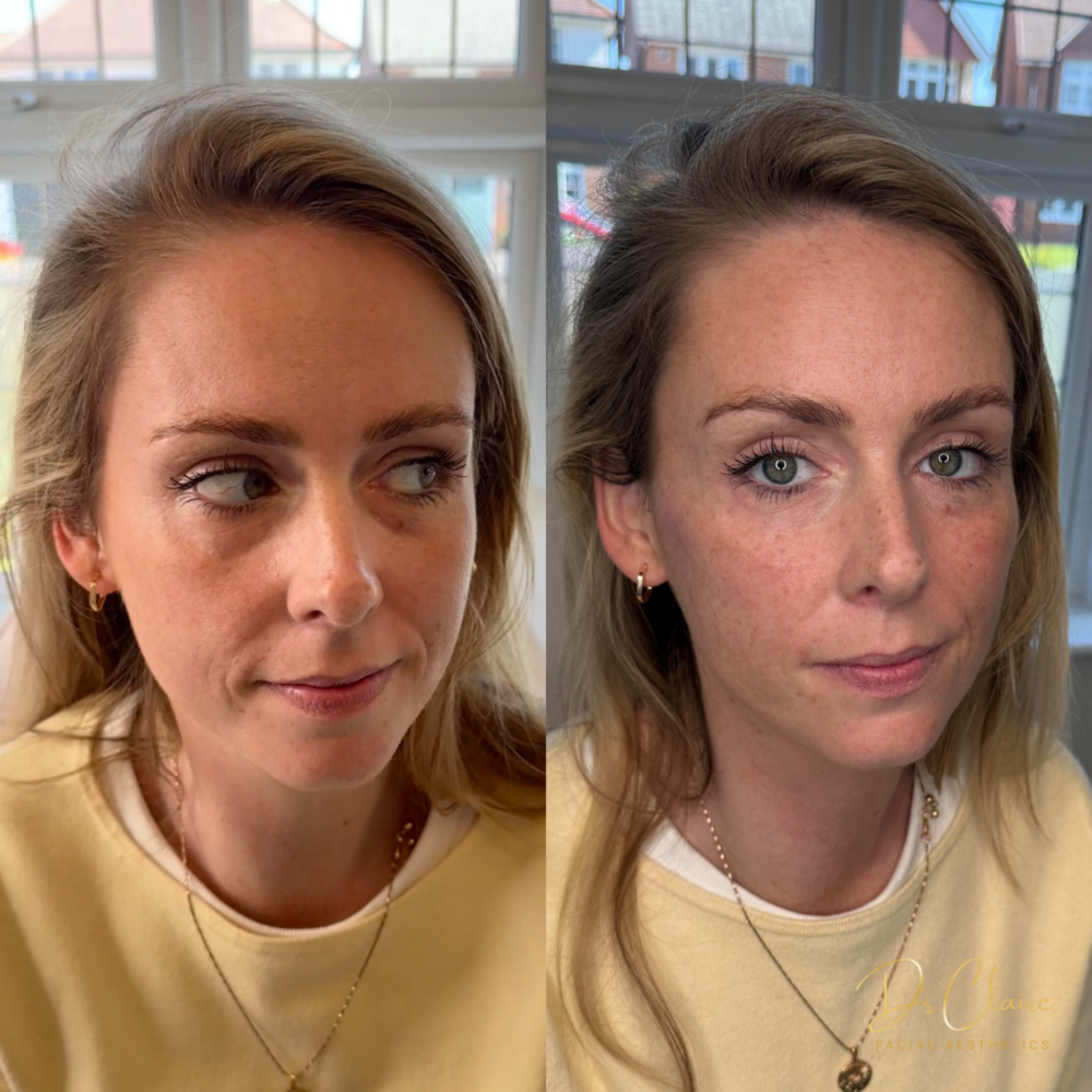 Transformations | Dr Claire Facial Aesthetics | Botox Chorley | Fillers Chorley | Aesthetics Chorley | Botox Treatments Chorley | Dermal Fillers Chorley | Aesthetic Enhancements Chorley