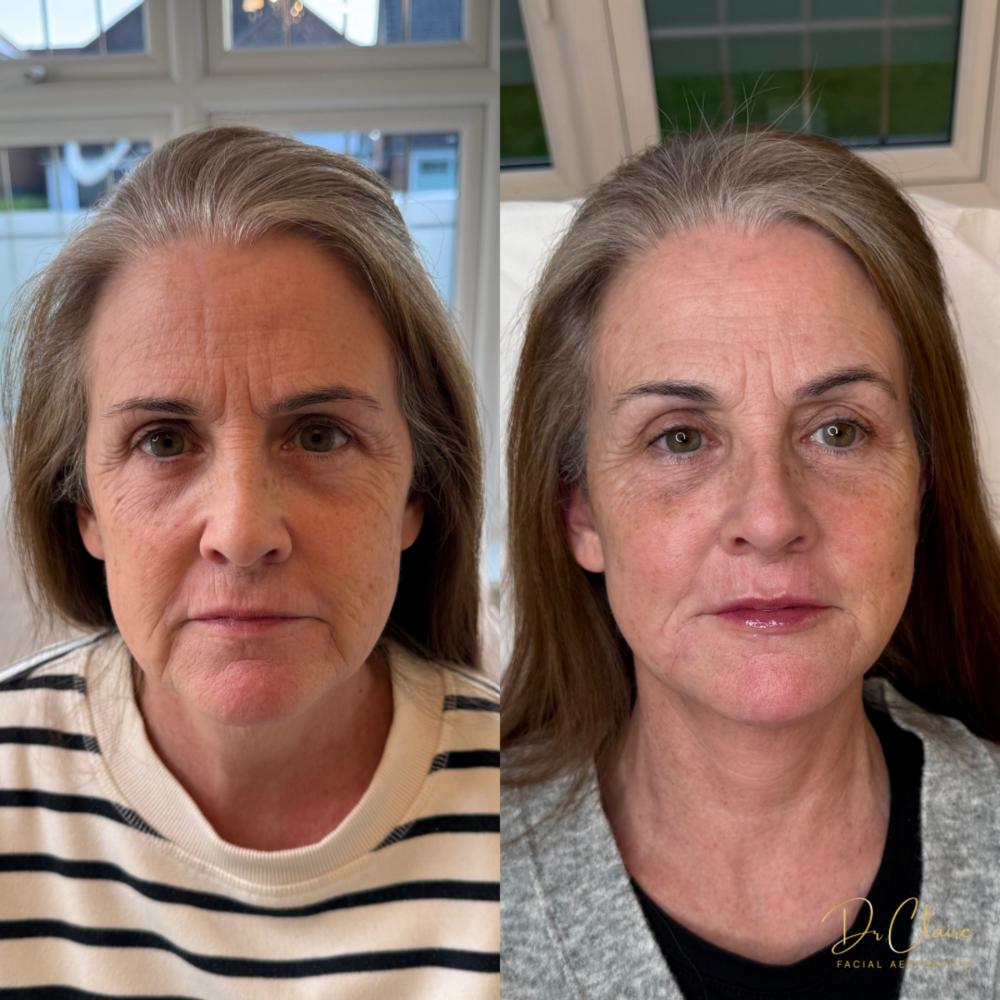 Transformations | Dr Claire Facial Aesthetics | Botox Chorley | Fillers Chorley | Aesthetics Chorley | Botox Treatments Chorley | Dermal Fillers Chorley | Aesthetic Enhancements Chorley
