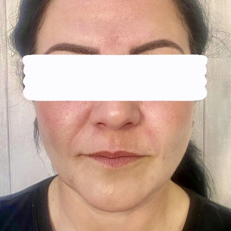 Before & After Results