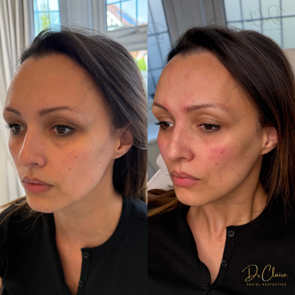 Transformations | Dr Claire Facial Aesthetics | Botox Chorley | Fillers Chorley | Aesthetics Chorley | Botox Treatments Chorley | Dermal Fillers Chorley | Aesthetic Enhancements Chorley