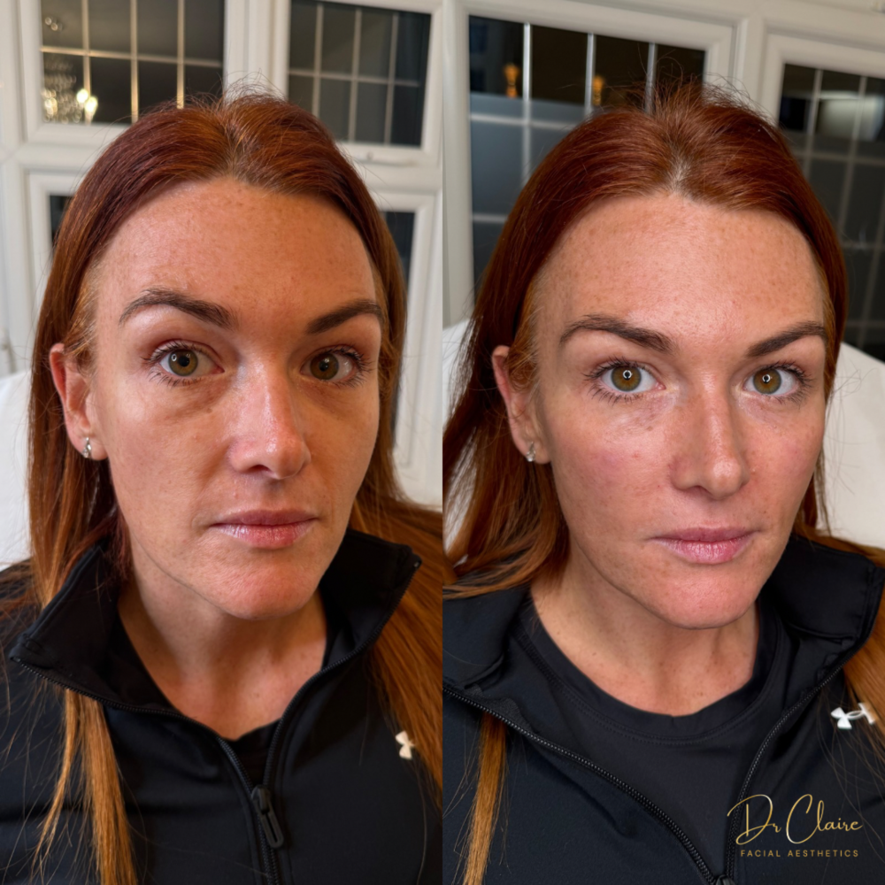 Transformations | Dr Claire Facial Aesthetics | Botox Chorley | Fillers Chorley | Aesthetics Chorley | Botox Treatments Chorley | Dermal Fillers Chorley | Aesthetic Enhancements Chorley