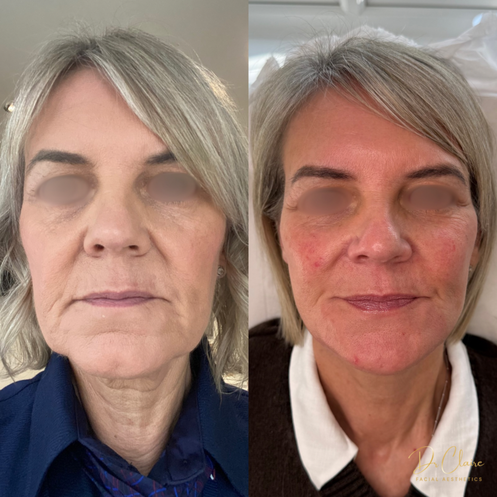 Transformations | Dr Claire Facial Aesthetics | Botox Chorley | Fillers Chorley | Aesthetics Chorley | Botox Treatments Chorley | Dermal Fillers Chorley | Aesthetic Enhancements Chorley