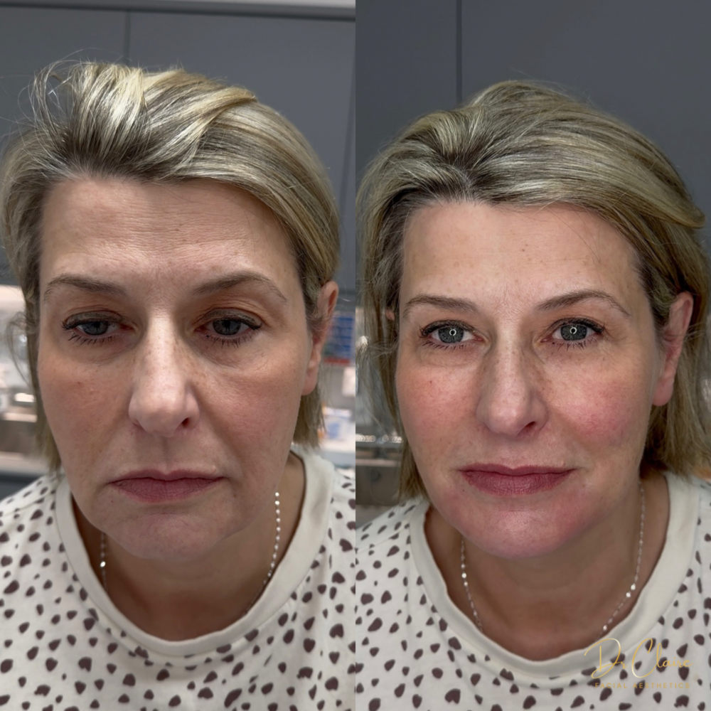 Transformations | Dr Claire Facial Aesthetics | Botox Chorley | Fillers Chorley | Aesthetics Chorley | Botox Treatments Chorley | Dermal Fillers Chorley | Aesthetic Enhancements Chorley