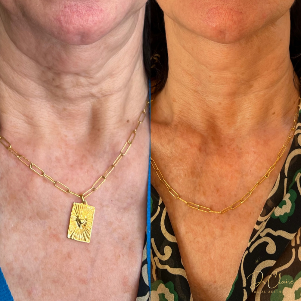 Transformations | Dr Claire Facial Aesthetics | Botox Chorley | Fillers Chorley | Aesthetics Chorley | Botox Treatments Chorley | Dermal Fillers Chorley | Aesthetic Enhancements Chorley