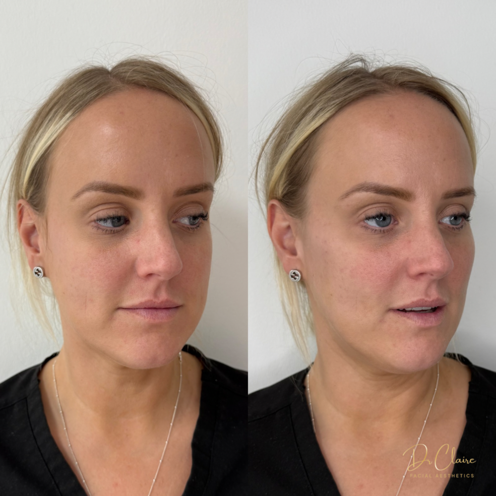 Transformations | Dr Claire Facial Aesthetics | Botox Chorley | Fillers Chorley | Aesthetics Chorley | Botox Treatments Chorley | Dermal Fillers Chorley | Aesthetic Enhancements Chorley