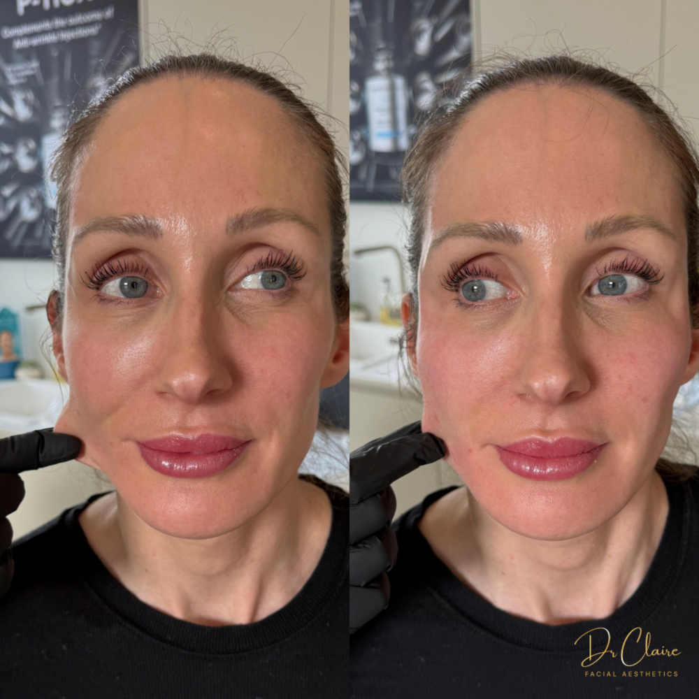 Transformations | Dr Claire Facial Aesthetics | Botox Chorley | Fillers Chorley | Aesthetics Chorley | Botox Treatments Chorley | Dermal Fillers Chorley | Aesthetic Enhancements Chorley