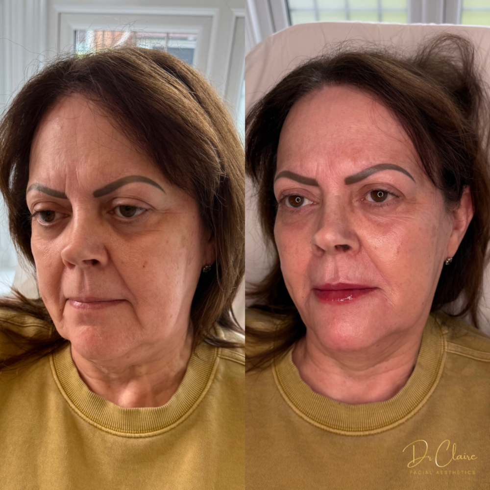 Transformations | Dr Claire Facial Aesthetics | Botox Chorley | Fillers Chorley | Aesthetics Chorley | Botox Treatments Chorley | Dermal Fillers Chorley | Aesthetic Enhancements Chorley