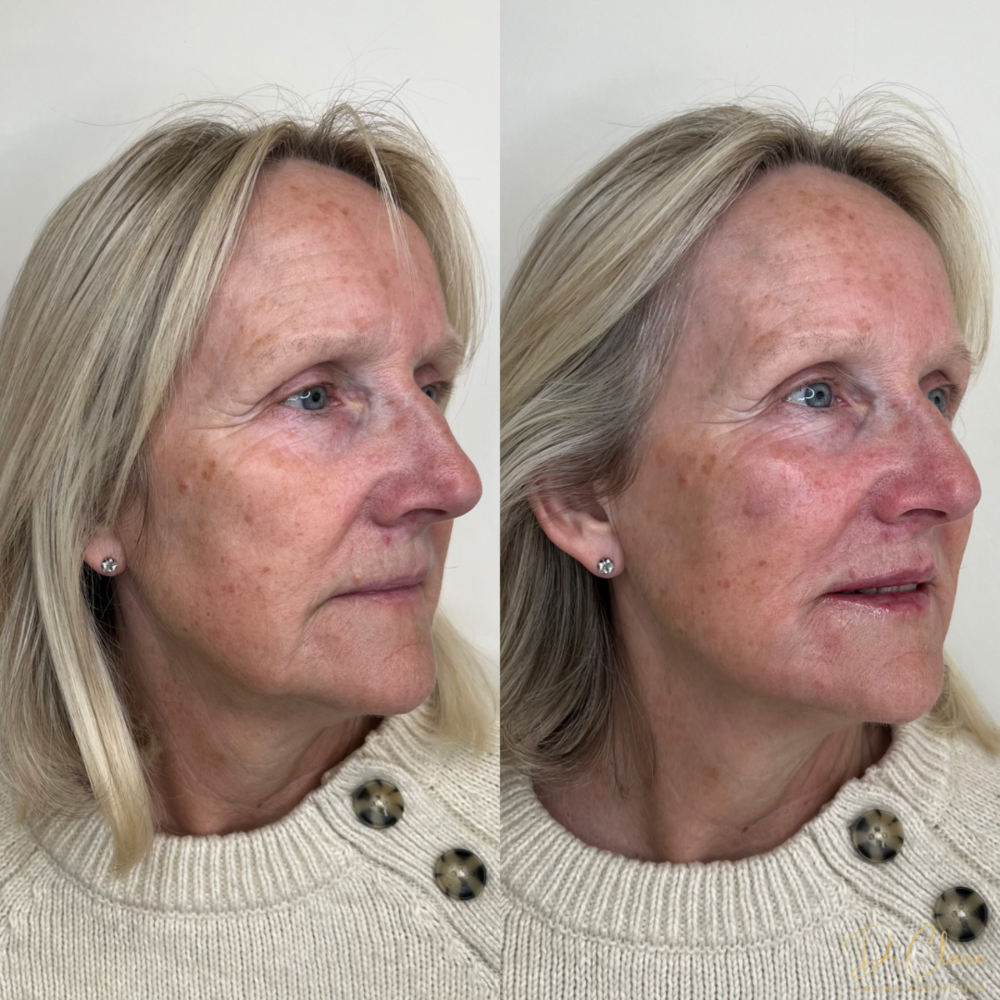 Transformations | Dr Claire Facial Aesthetics | Botox Chorley | Fillers Chorley | Aesthetics Chorley | Botox Treatments Chorley | Dermal Fillers Chorley | Aesthetic Enhancements Chorley