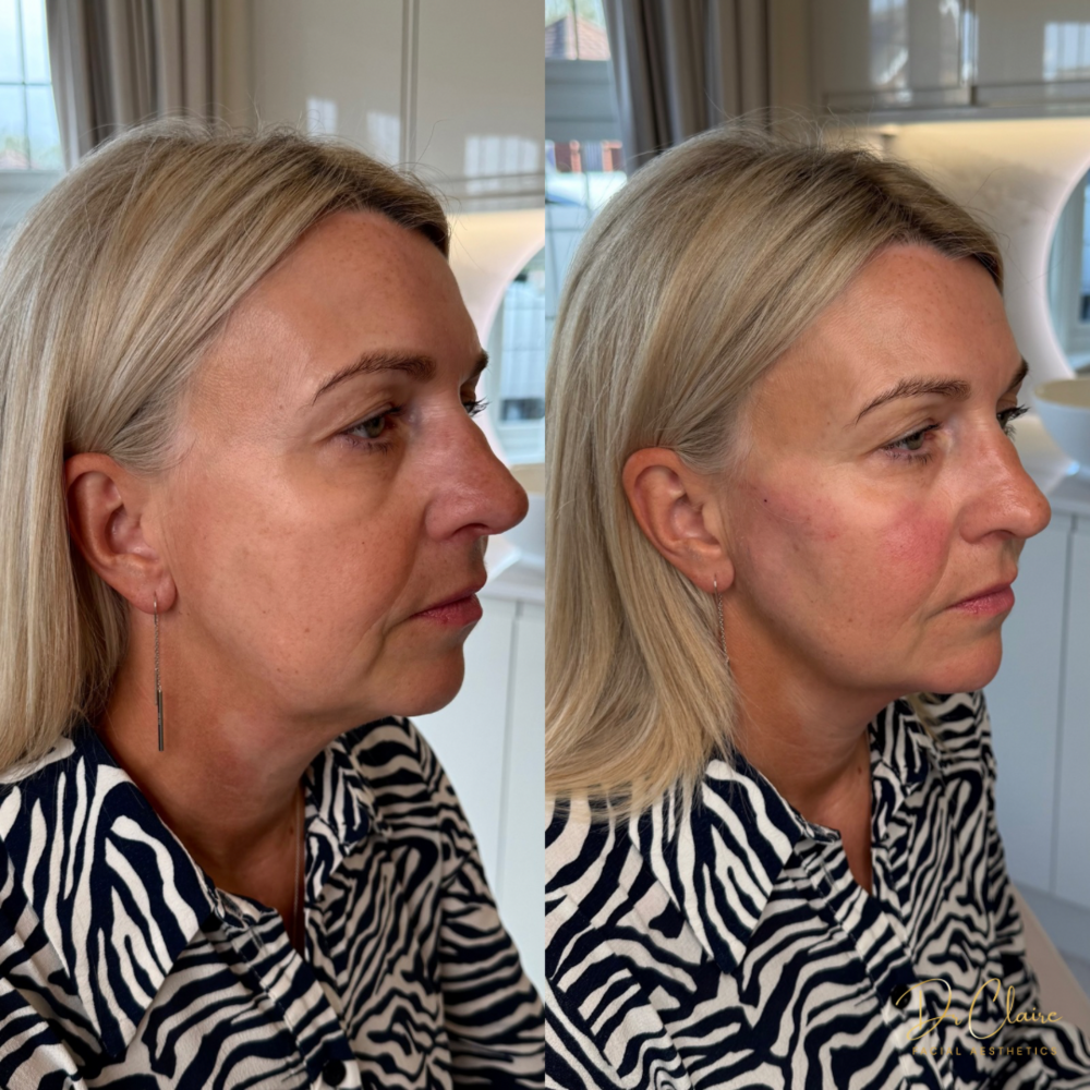 Transformations | Dr Claire Facial Aesthetics | Botox Chorley | Fillers Chorley | Aesthetics Chorley | Botox Treatments Chorley | Dermal Fillers Chorley | Aesthetic Enhancements Chorley