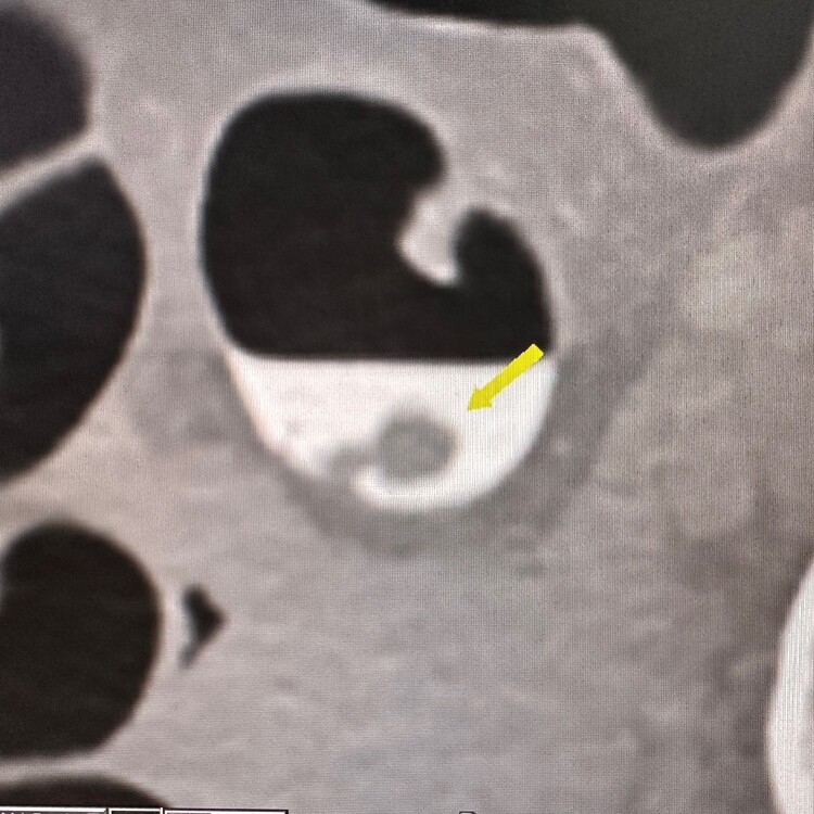 CT Colonography