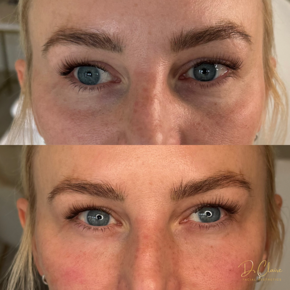 Transformations | Dr Claire Facial Aesthetics | Botox Chorley | Fillers Chorley | Aesthetics Chorley | Botox Treatments Chorley | Dermal Fillers Chorley | Aesthetic Enhancements Chorley