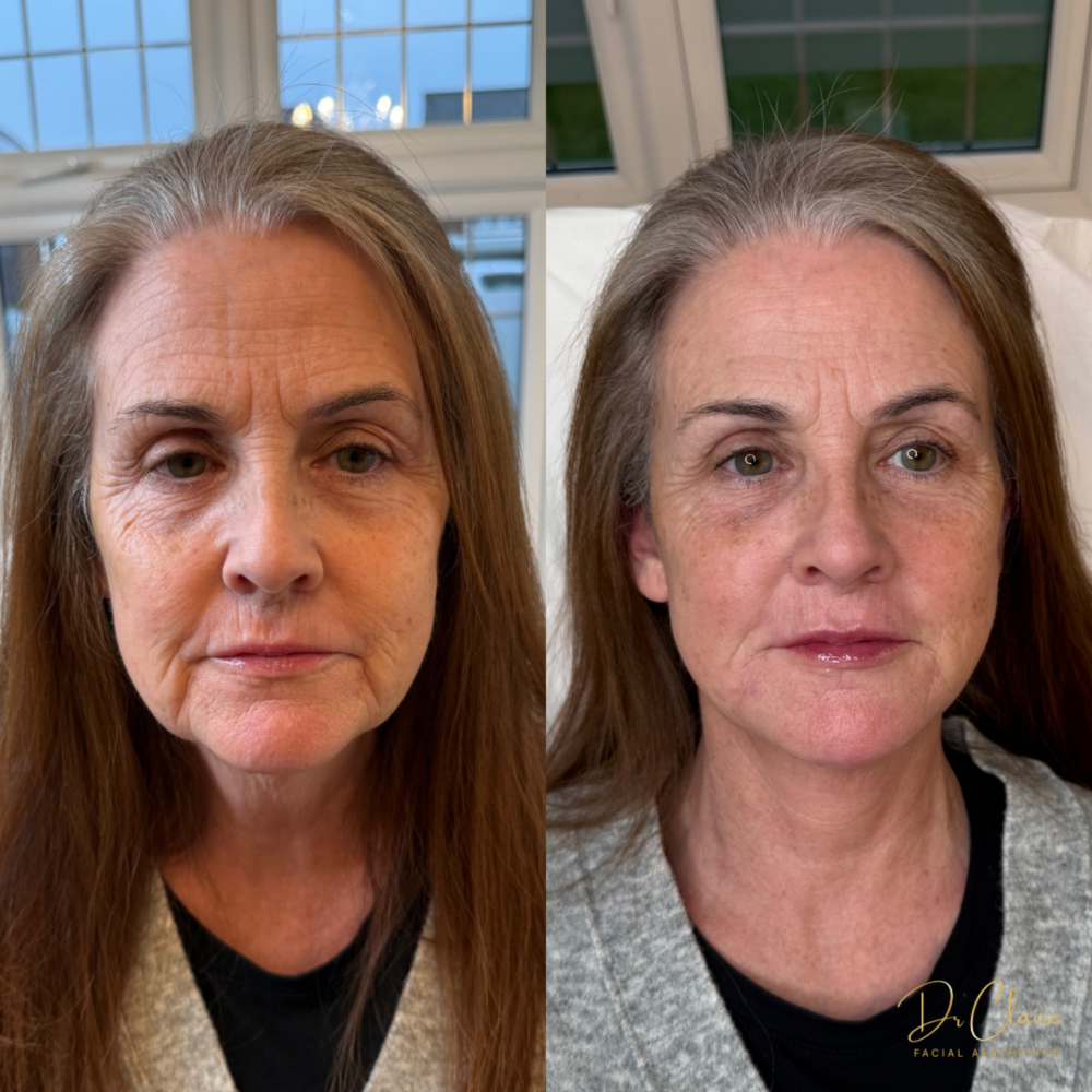 Transformations | Dr Claire Facial Aesthetics | Botox Chorley | Fillers Chorley | Aesthetics Chorley | Botox Treatments Chorley | Dermal Fillers Chorley | Aesthetic Enhancements Chorley