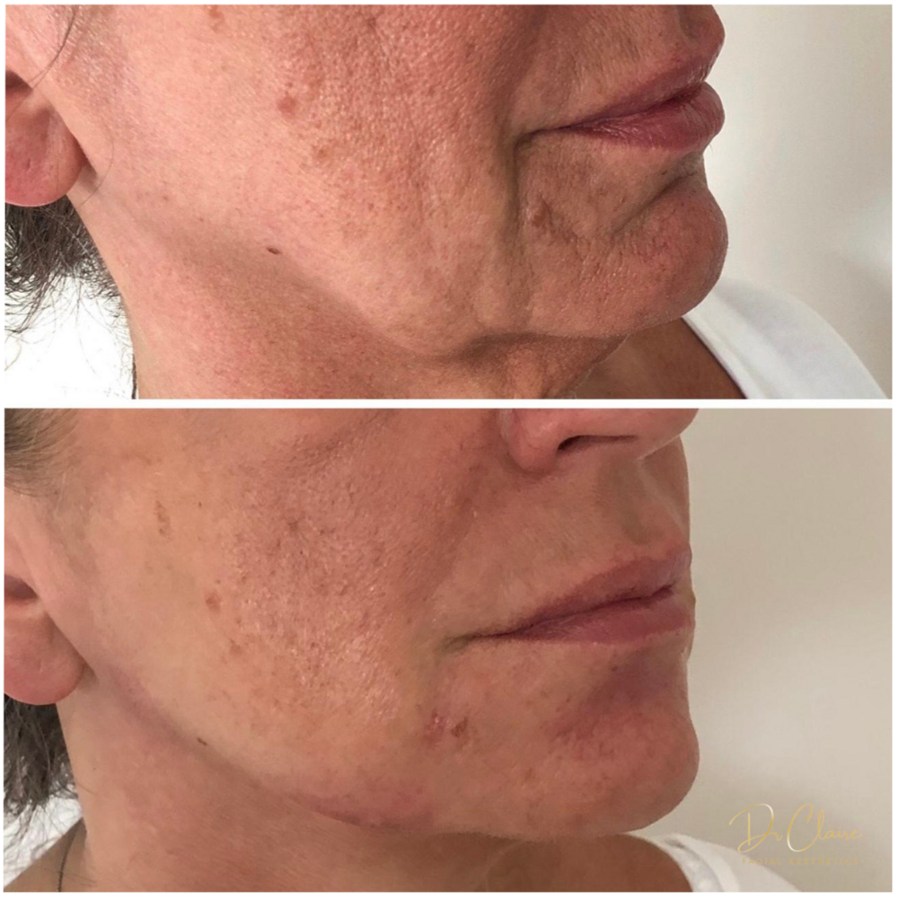 Transformations | Dr Claire Facial Aesthetics | Botox Chorley | Fillers Chorley | Aesthetics Chorley | Botox Treatments Chorley | Dermal Fillers Chorley | Aesthetic Enhancements Chorley