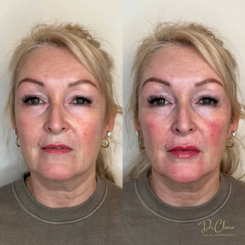 Transformations | Dr Claire Facial Aesthetics | Botox Chorley | Fillers Chorley | Aesthetics Chorley | Botox Treatments Chorley | Dermal Fillers Chorley | Aesthetic Enhancements Chorley