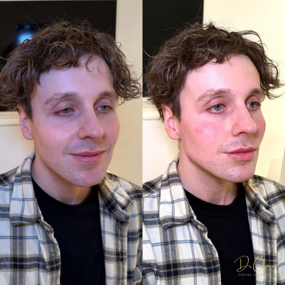 Transformations | Dr Claire Facial Aesthetics | Botox Chorley | Fillers Chorley | Aesthetics Chorley | Botox Treatments Chorley | Dermal Fillers Chorley | Aesthetic Enhancements Chorley