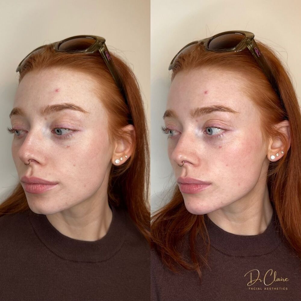 Transformations | Dr Claire Facial Aesthetics | Botox Chorley | Fillers Chorley | Aesthetics Chorley | Botox Treatments Chorley | Dermal Fillers Chorley | Aesthetic Enhancements Chorley