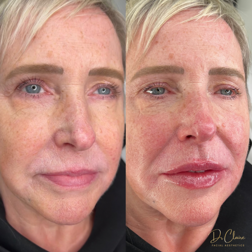 Transformations | Dr Claire Facial Aesthetics | Botox Chorley | Fillers Chorley | Aesthetics Chorley | Botox Treatments Chorley | Dermal Fillers Chorley | Aesthetic Enhancements Chorley