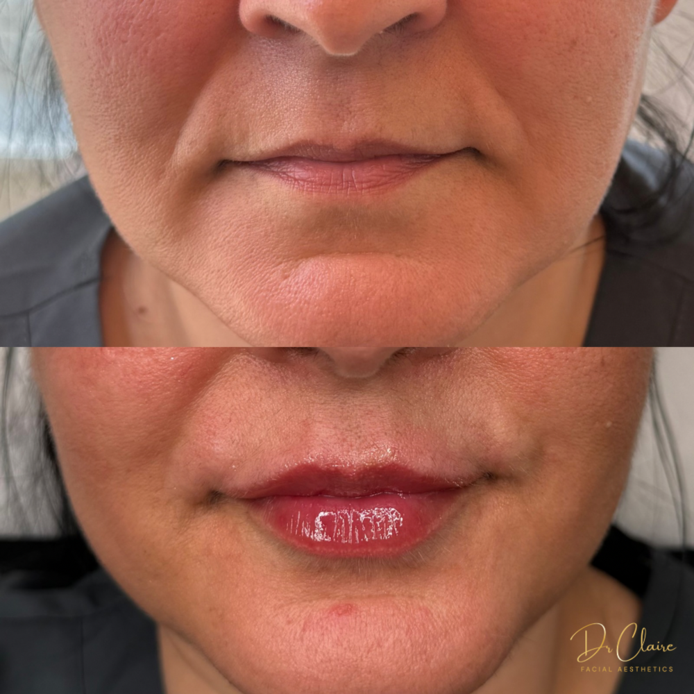 Transformations | Dr Claire Facial Aesthetics | Botox Chorley | Fillers Chorley | Aesthetics Chorley | Botox Treatments Chorley | Dermal Fillers Chorley | Aesthetic Enhancements Chorley