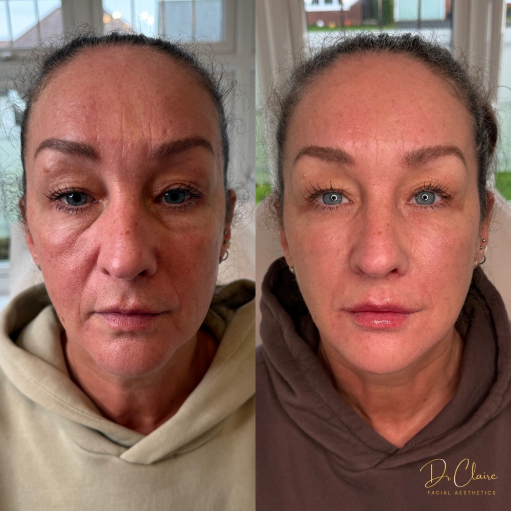 Transformations | Dr Claire Facial Aesthetics | Botox Chorley | Fillers Chorley | Aesthetics Chorley | Botox Treatments Chorley | Dermal Fillers Chorley | Aesthetic Enhancements Chorley