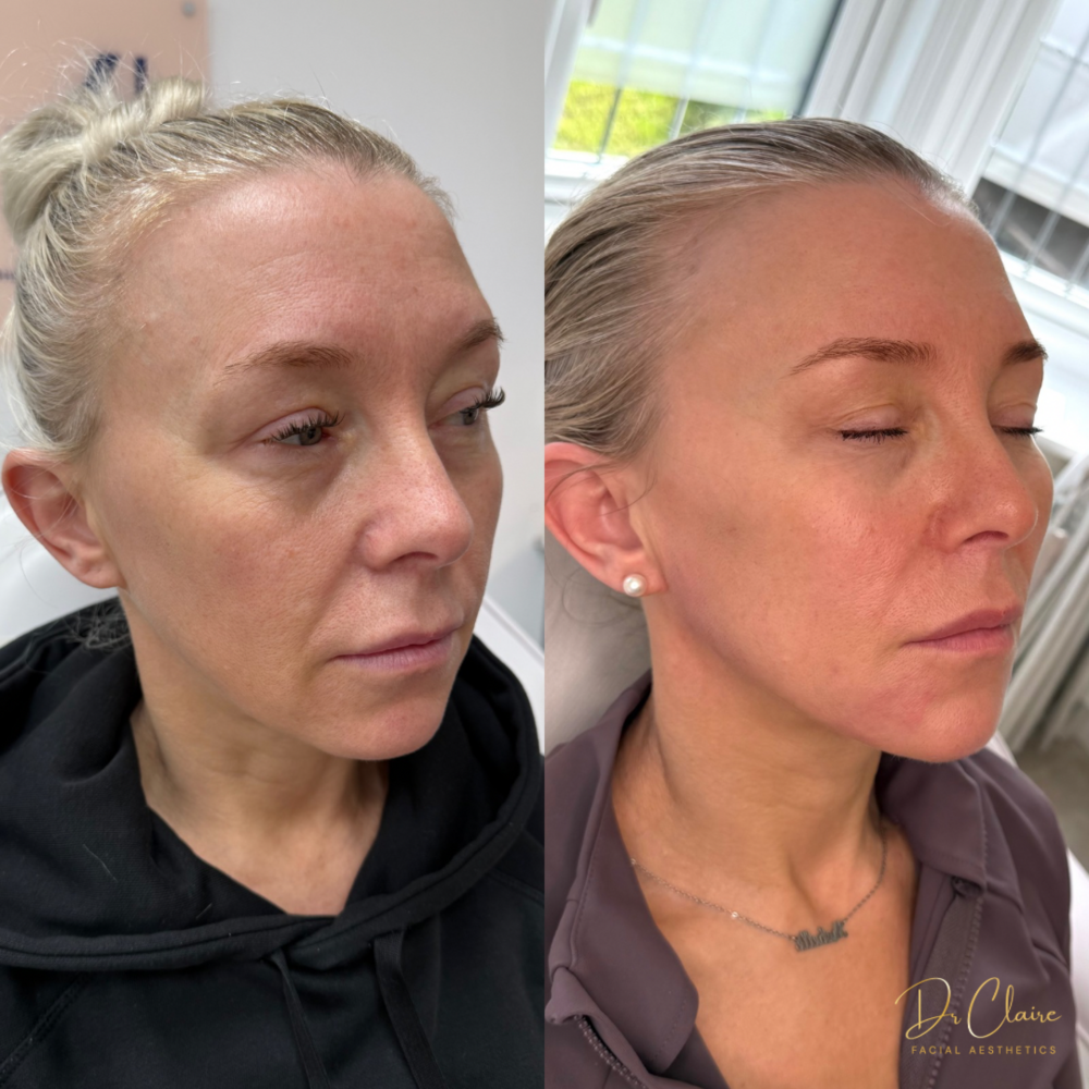 Transformations | Dr Claire Facial Aesthetics | Botox Chorley | Fillers Chorley | Aesthetics Chorley | Botox Treatments Chorley | Dermal Fillers Chorley | Aesthetic Enhancements Chorley