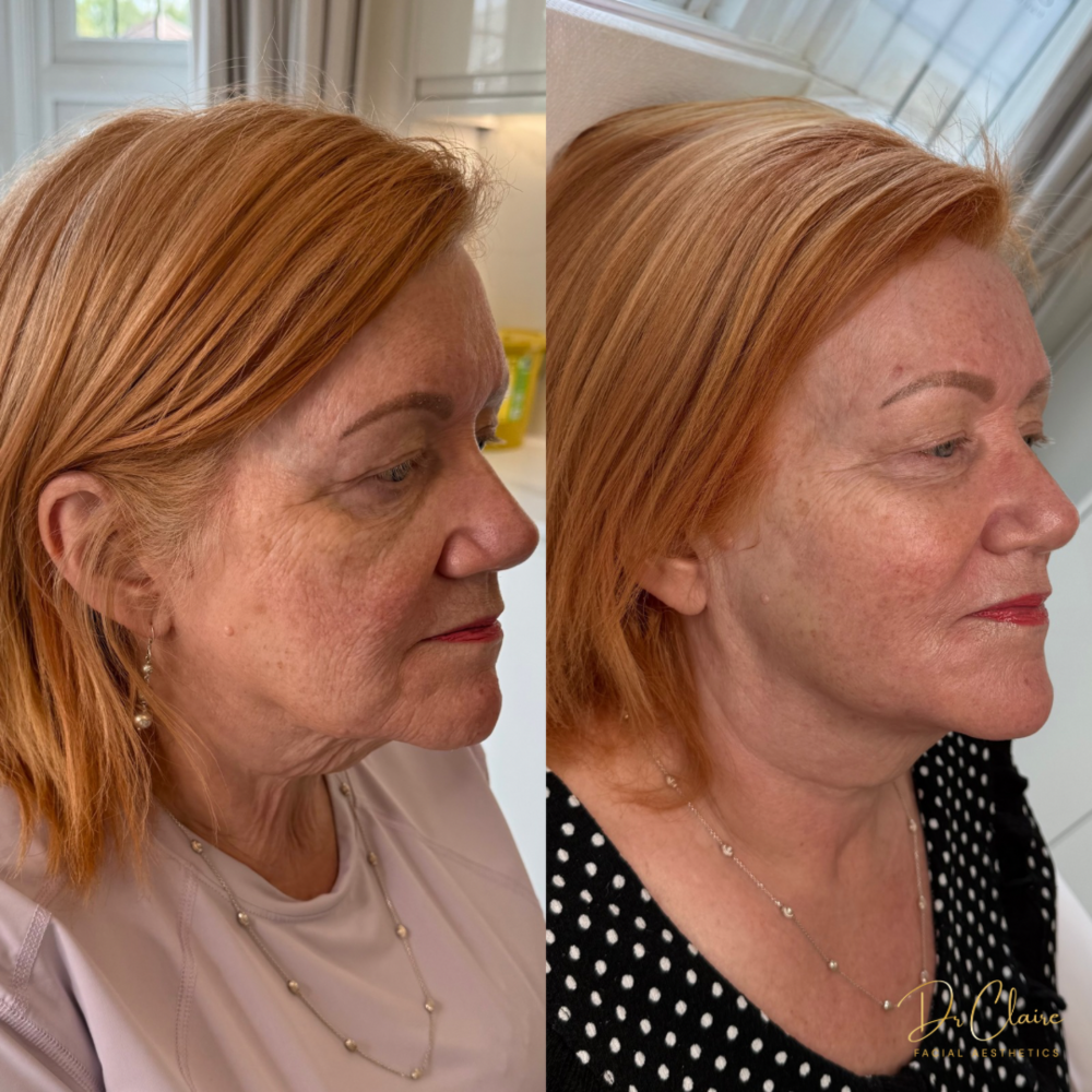 Transformations | Dr Claire Facial Aesthetics | Botox Chorley | Fillers Chorley | Aesthetics Chorley | Botox Treatments Chorley | Dermal Fillers Chorley | Aesthetic Enhancements Chorley