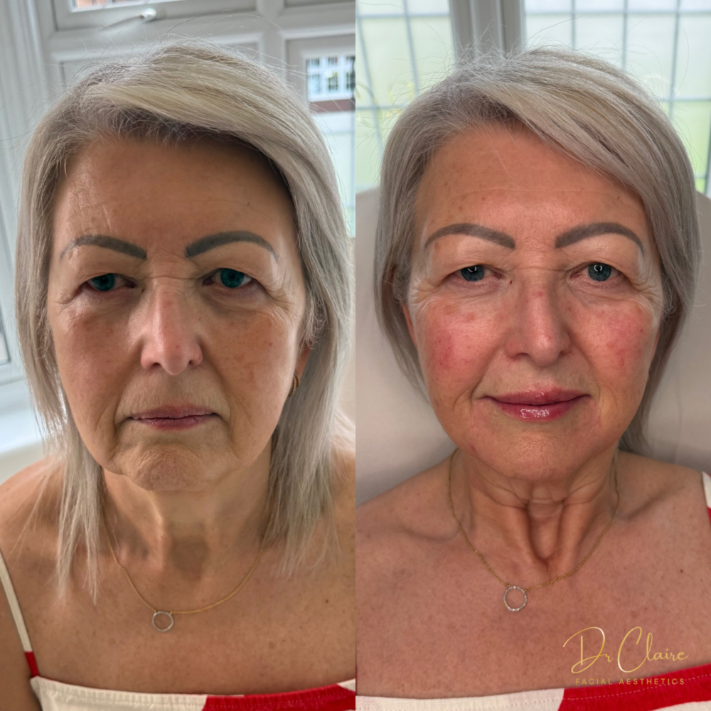 Transformations | Dr Claire Facial Aesthetics | Botox Chorley | Fillers Chorley | Aesthetics Chorley | Botox Treatments Chorley | Dermal Fillers Chorley | Aesthetic Enhancements Chorley