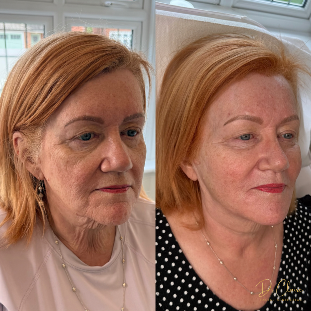 Transformations | Dr Claire Facial Aesthetics | Botox Chorley | Fillers Chorley | Aesthetics Chorley | Botox Treatments Chorley | Dermal Fillers Chorley | Aesthetic Enhancements Chorley