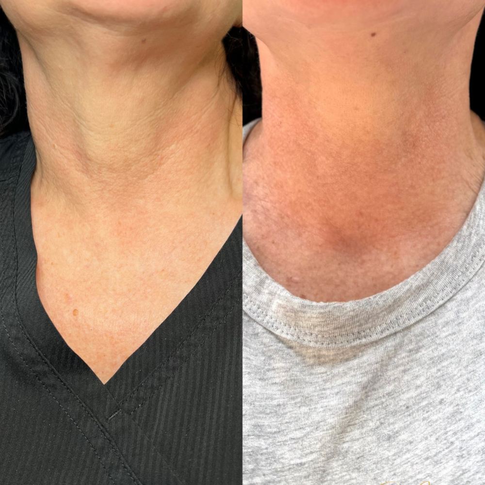 Transformations | Dr Claire Facial Aesthetics | Botox Chorley | Fillers Chorley | Aesthetics Chorley | Botox Treatments Chorley | Dermal Fillers Chorley | Aesthetic Enhancements Chorley
