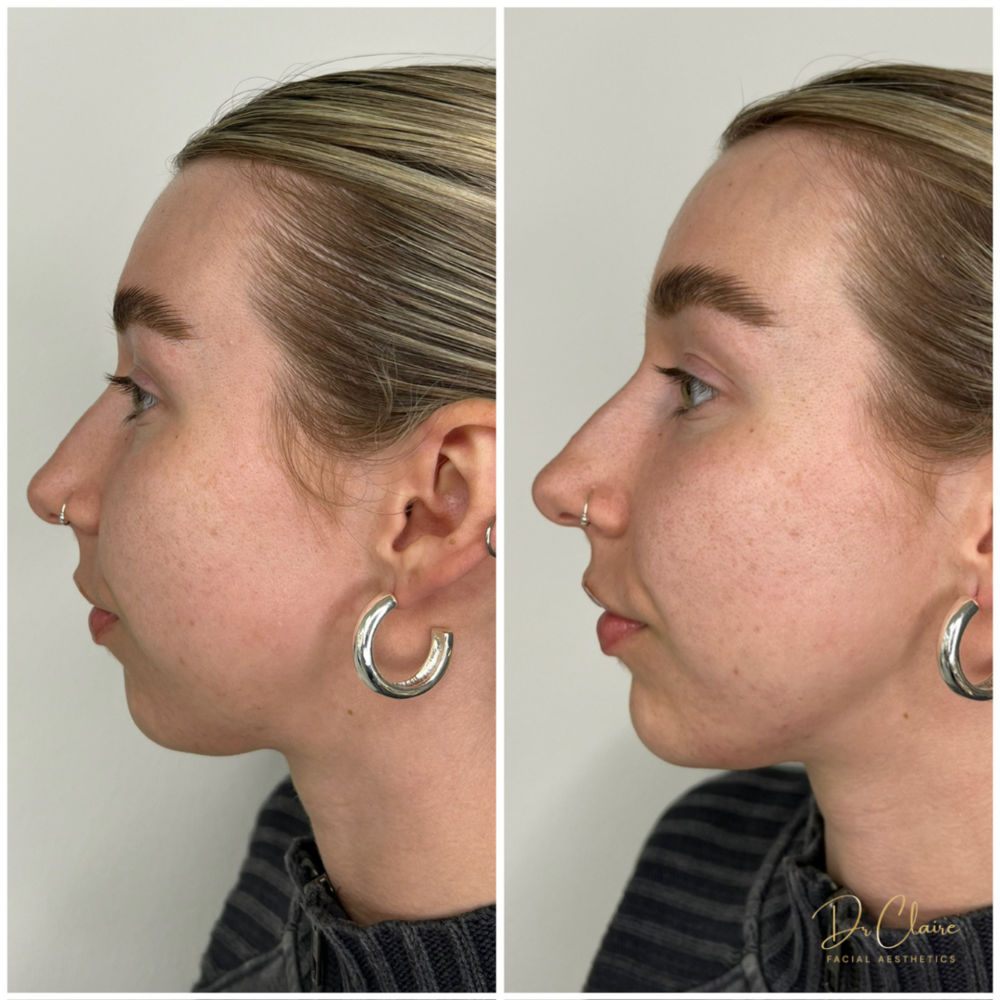 Transformations | Dr Claire Facial Aesthetics | Botox Chorley | Fillers Chorley | Aesthetics Chorley | Botox Treatments Chorley | Dermal Fillers Chorley | Aesthetic Enhancements Chorley