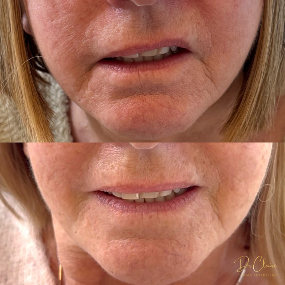 Transformations | Dr Claire Facial Aesthetics | Botox Chorley | Fillers Chorley | Aesthetics Chorley | Botox Treatments Chorley | Dermal Fillers Chorley | Aesthetic Enhancements Chorley