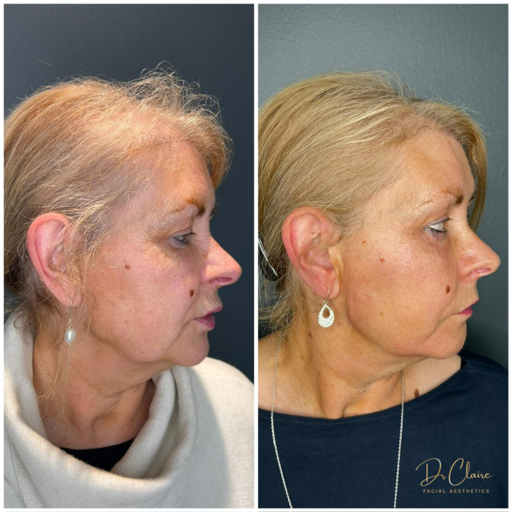 Transformations | Dr Claire Facial Aesthetics | Botox Chorley | Fillers Chorley | Aesthetics Chorley | Botox Treatments Chorley | Dermal Fillers Chorley | Aesthetic Enhancements Chorley