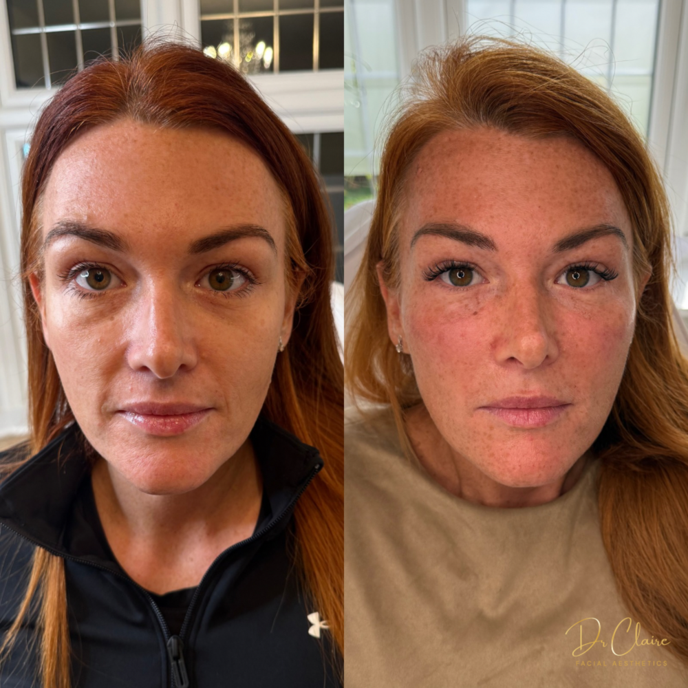 Transformations | Dr Claire Facial Aesthetics | Botox Chorley | Fillers Chorley | Aesthetics Chorley | Botox Treatments Chorley | Dermal Fillers Chorley | Aesthetic Enhancements Chorley