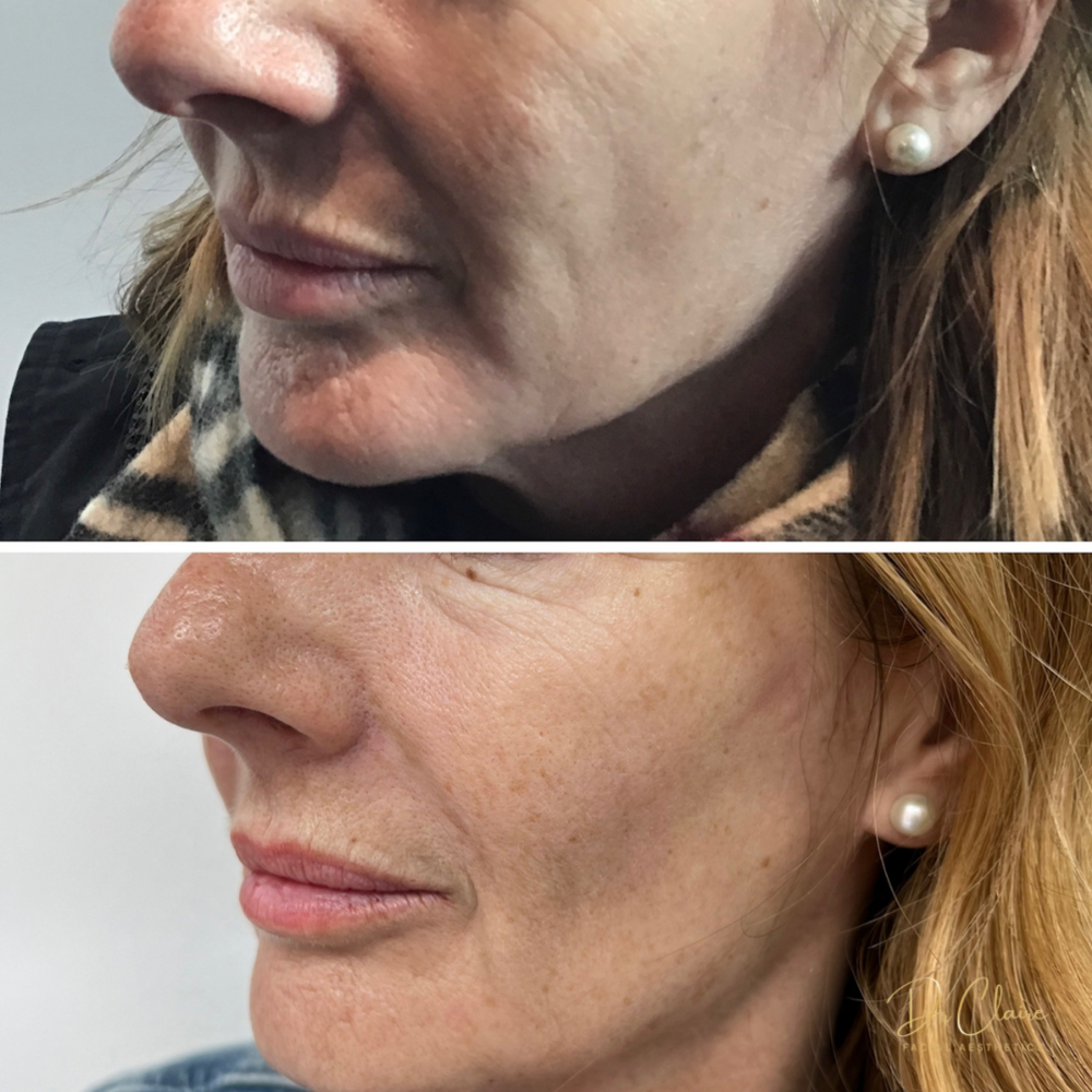 Transformations | Dr Claire Facial Aesthetics | Botox Chorley | Fillers Chorley | Aesthetics Chorley | Botox Treatments Chorley | Dermal Fillers Chorley | Aesthetic Enhancements Chorley