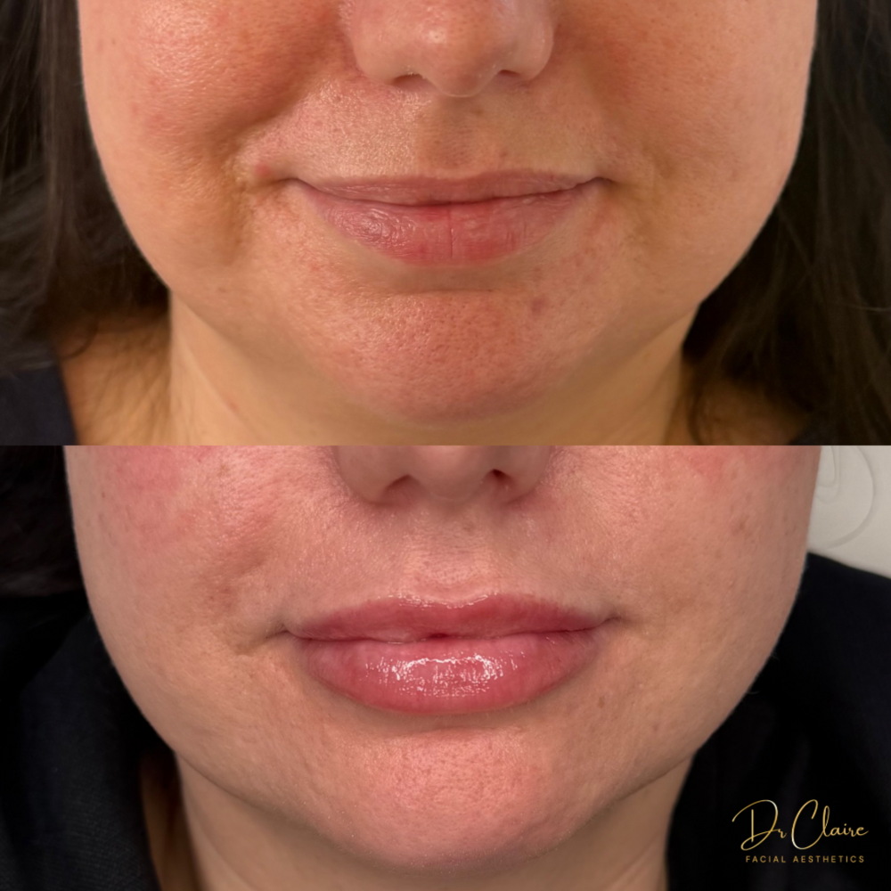 Transformations | Dr Claire Facial Aesthetics | Botox Chorley | Fillers Chorley | Aesthetics Chorley | Botox Treatments Chorley | Dermal Fillers Chorley | Aesthetic Enhancements Chorley